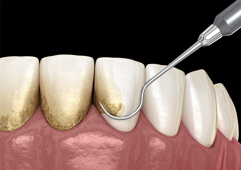 歯周病は歯を失う大きな原因の一つです